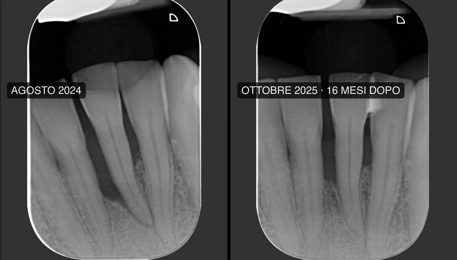 Radiografie prima e dopo: difetto osseo parodontale e osso rigenerato 16 mesi dopo la terapia - Centro Odontoiatrico Leone, Gravina in Puglia